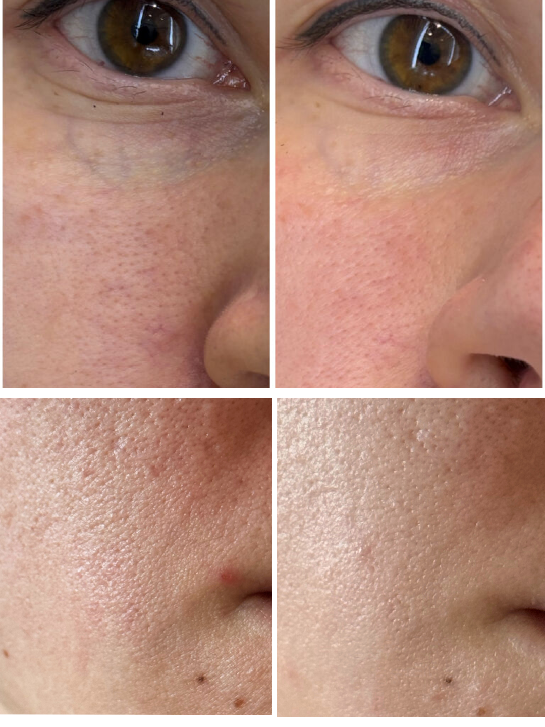 Сыворотка для сужения пор Surgene Pores Corrector Serum